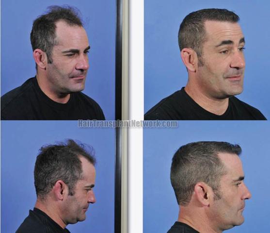 Hair transplantation surgery before and after images