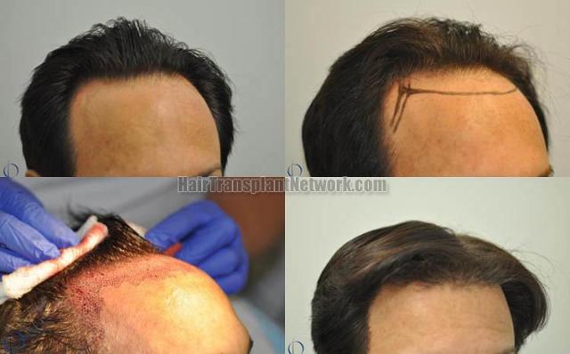 Hair transplantation surgery before and after images