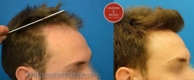 Hair restoration procedure before and after results