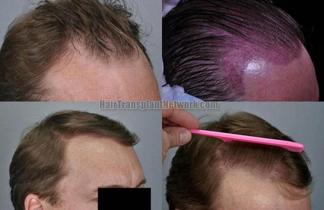 Hair transplantation surgery before and after pictures