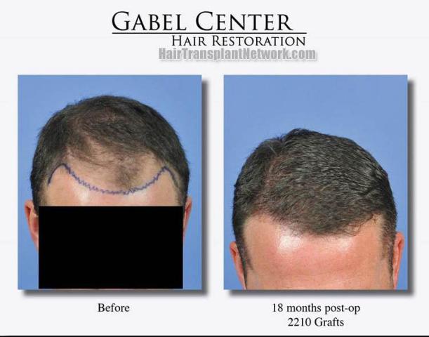 Hair transplantation surgery before and after pictures