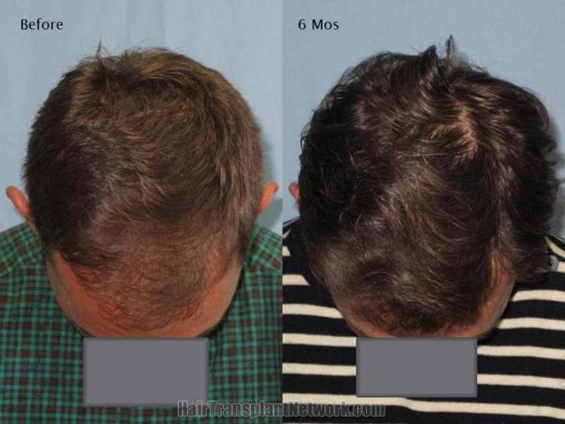 Hair transplantation surgery before and after photos