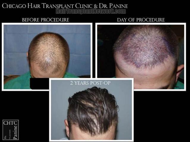 Top view before and after hair restoration results