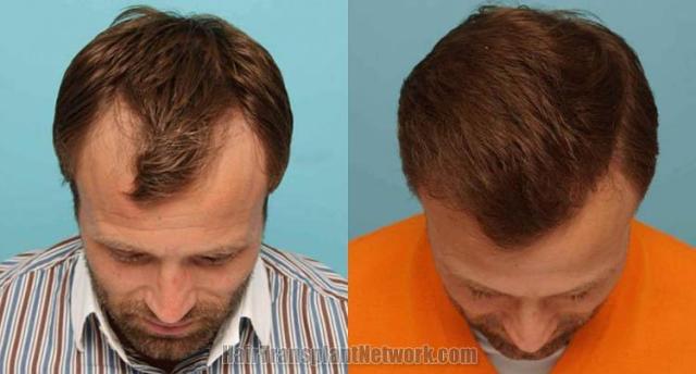 Hair transplantation surgery before and after photos