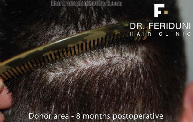 Hair restoration surgery before and after photos