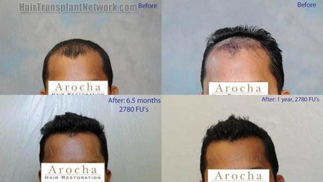 Hair restoration procedure before and after results