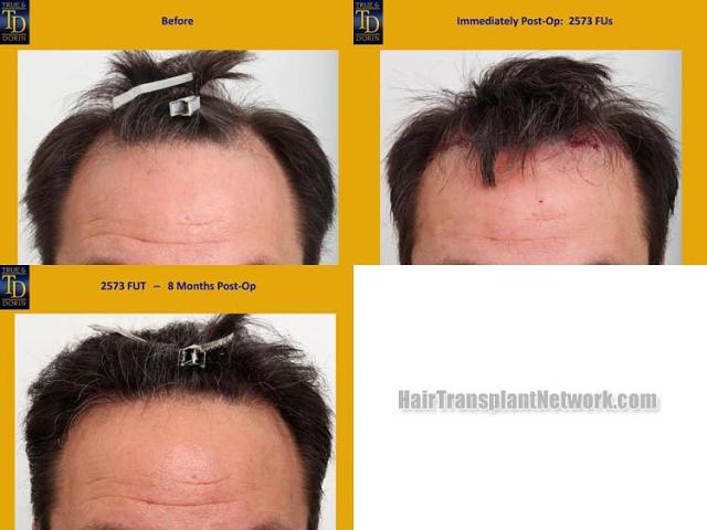 Hair restoration procedure before and after results