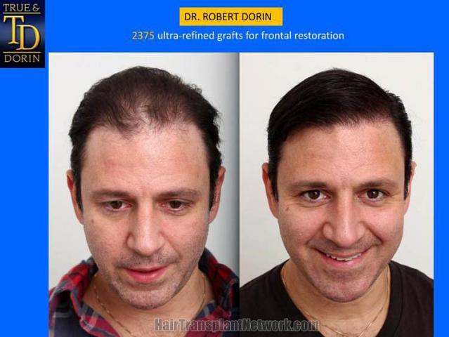 Hair restoration procedure before and after results