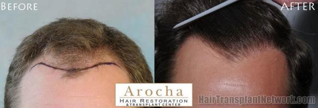 Before and after hair transplant procedure images