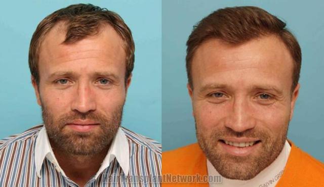 Hair restoration procedure before and after results