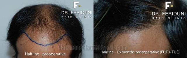 Hair restoration procedure before and after pictures