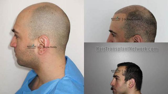 Hair transplantation surgery before and after images