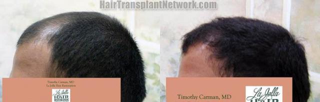 Hair transplantation surgery before and after pictures