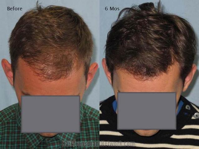 Hair restoration procedure before and after pictures