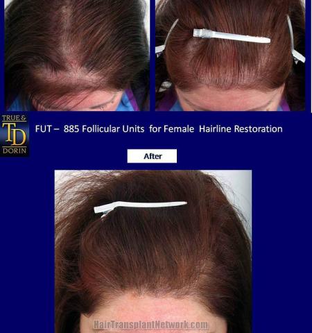 Hair transplantation surgery before and after photos