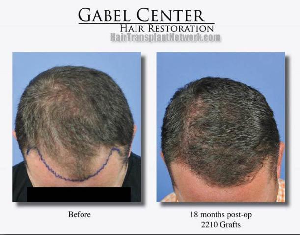 Top view - Before and after surgical hair replacement