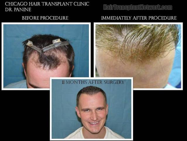 Before and after hair transplant procedure images