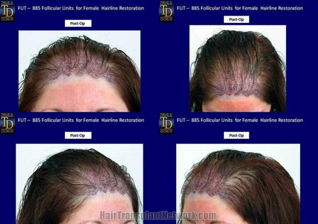 Hair restoration surgery before and after photos