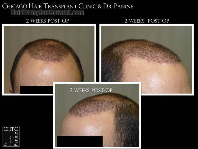 Hair transplantation surgery before and after pictures