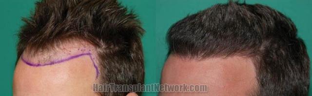 Hair transplantation surgery before and after photos