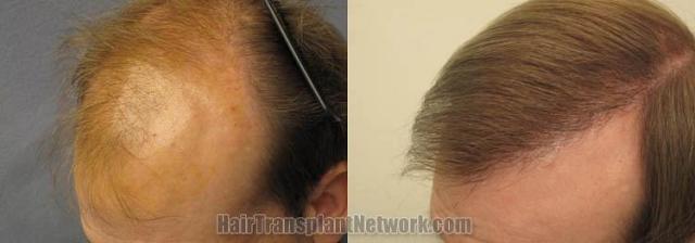 Hair restoration procedure before and after pictures