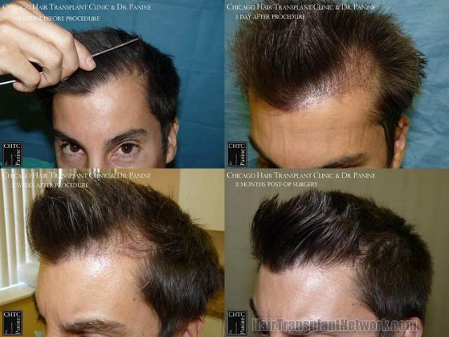 Hair transplantation surgery before and after photos