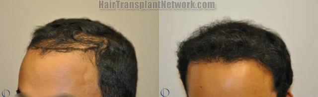 air transplantation surgery before and after images