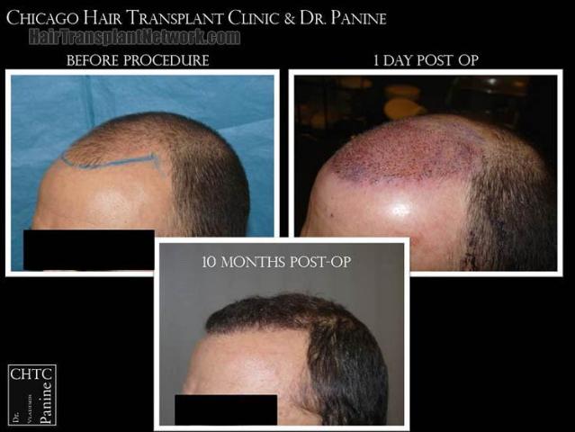 Hair transplantation surgery before and after images