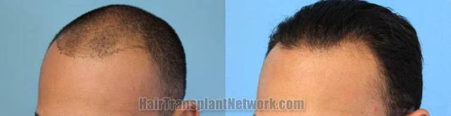 Hair transplantation surgery before and after pictures