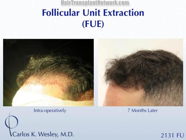 Hair transplantation surgery before and after photos