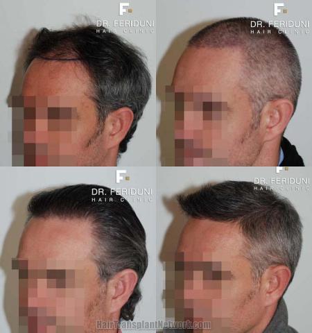 Hair restoration surgery before and after photos