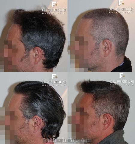 Hair transplantation surgery before and after photos