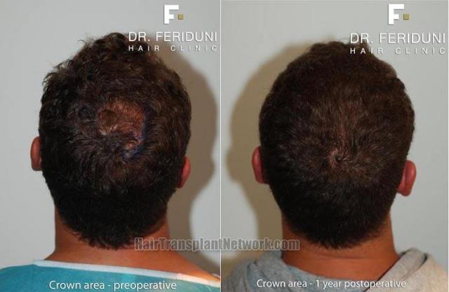 Hair restoration procedure before and after results