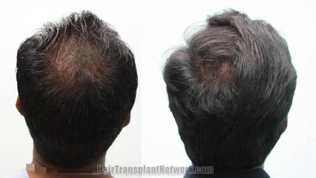 Hair transplantation surgery before and after pictures