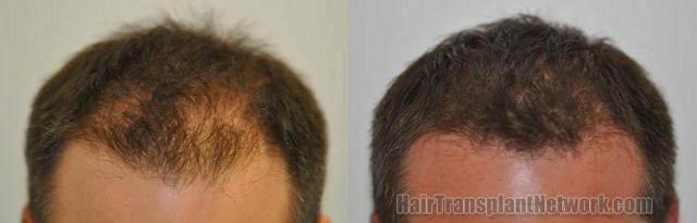 Before and after hair restoration photos