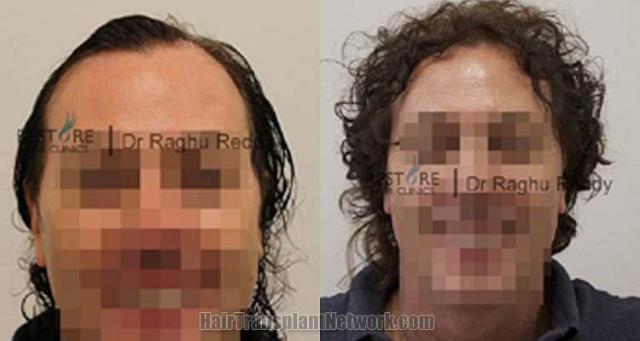 Before and after hair transplant procedure images