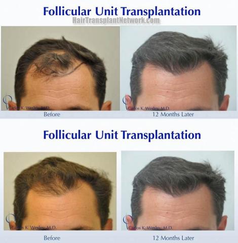 Hair transplantation surgery before and after photos