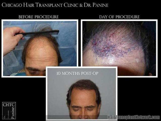 Hair transplantation surgery before and after images