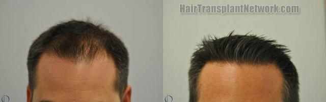 Before and after hair restoration result photographs