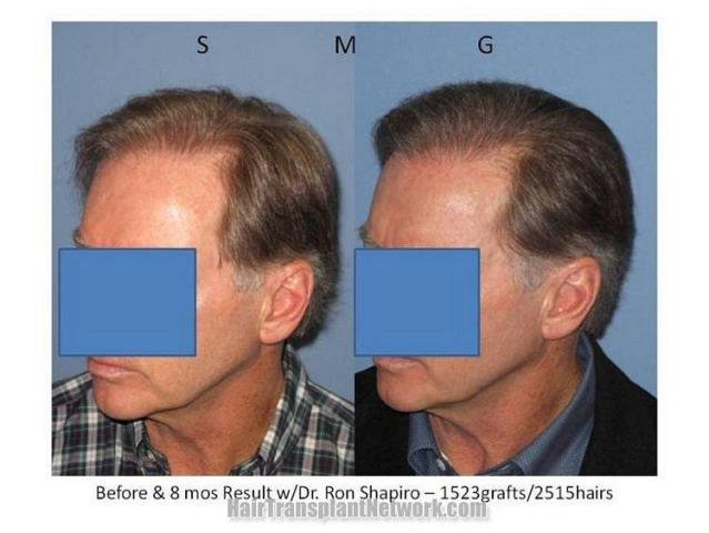 Left side hair transplant procedure photos