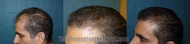 Hair transplantation before and after surgery