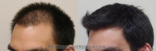 Hair restoration procedure before and after pictures