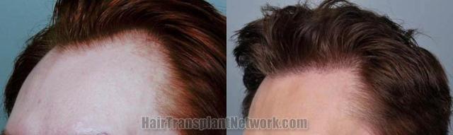 Hair transplantation surgery before and after pictures