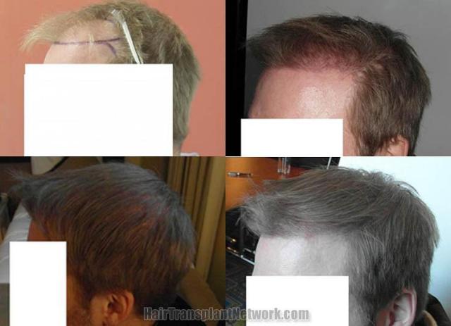 Hair transplantation surgery before and after pictures