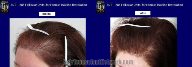 Hair transplantation surgery before and after pictures