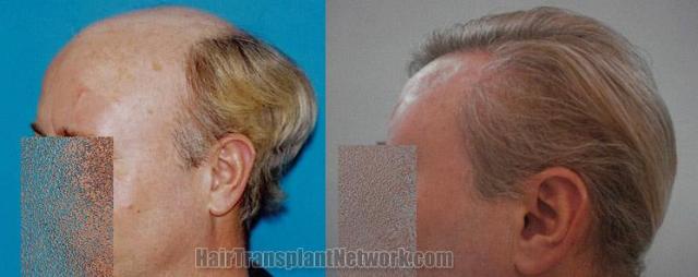 Hair restoration procedure before and after pictures