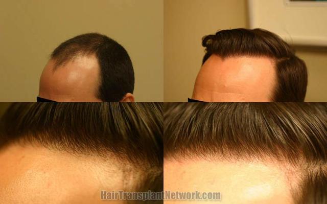 Hair transplantation surgery before and after photos