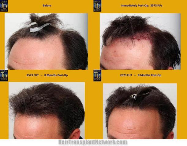 Hair transplantation surgery before and after pictures