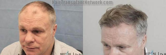 Hair transplantation surgery before and after images