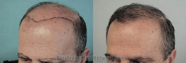 Hair transplantation surgery before and after images